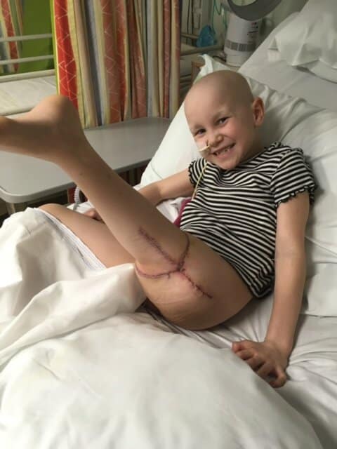Amelia Eldred, two days after surgery to reattach her leg backwards
